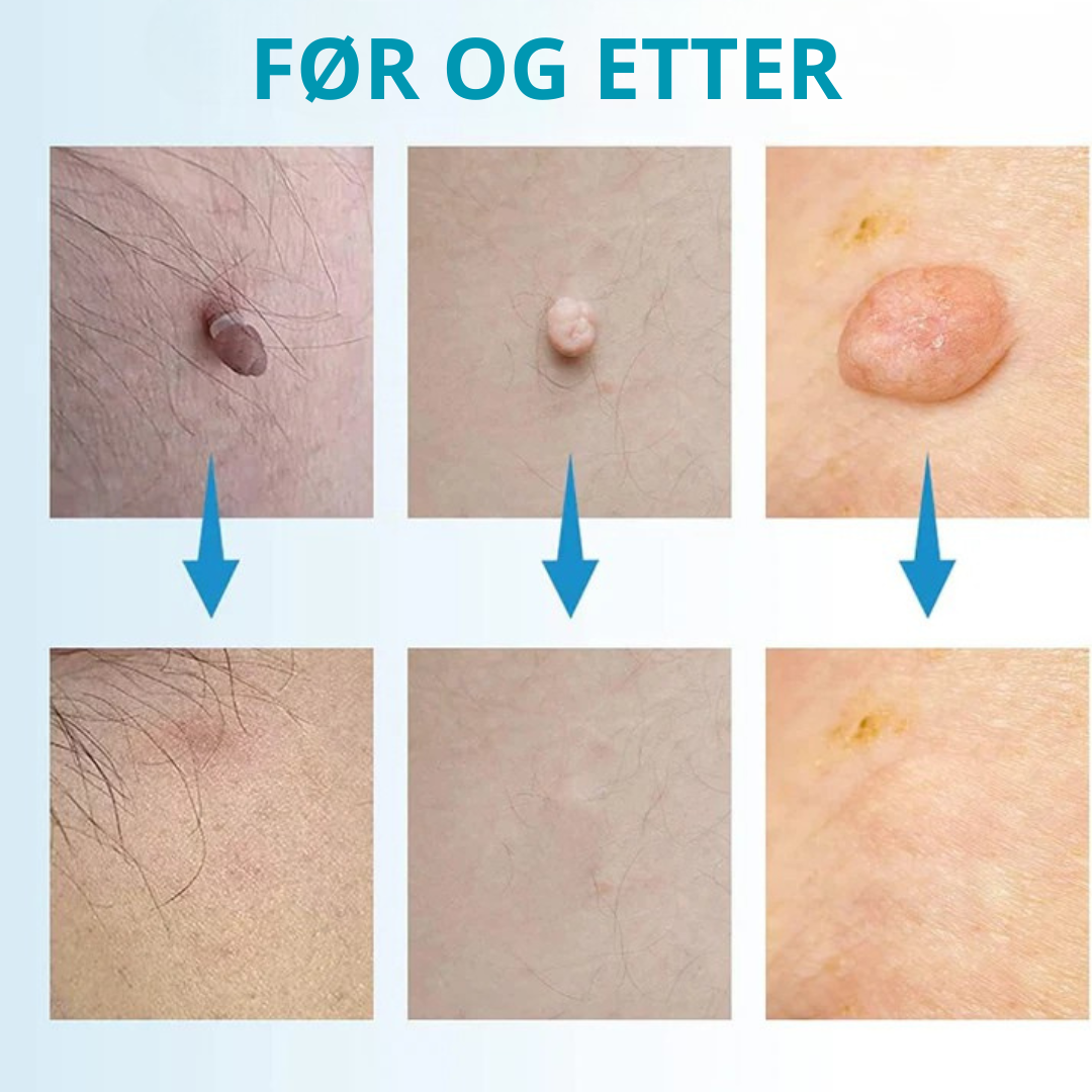Fjerning av Leverflekker - Bli kvitt fødselsmerker og Skintags