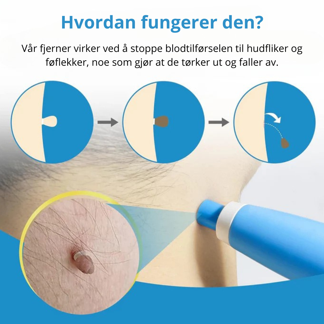 Fjerning av Leverflekker - Bli kvitt fødselsmerker og Skintags